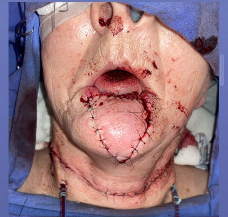 Tratamento contra câncer lábio e pescoço da minha vó 