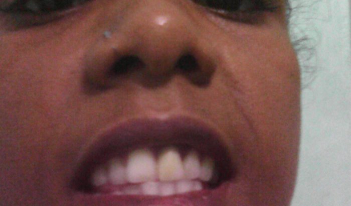 Implante dentario só um dente definitivo