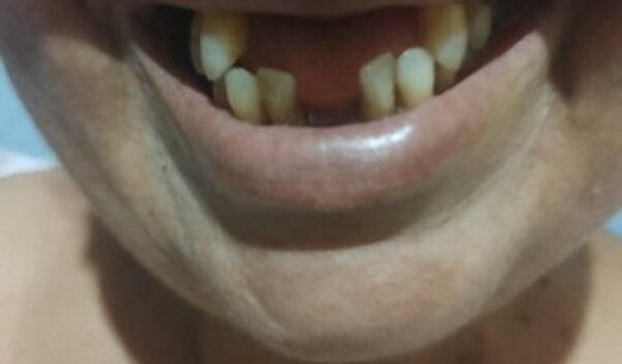 Ajuda para colocar um implante dentário