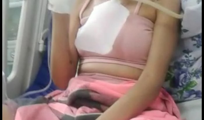 sarcoma alveolar de partes moles - (Vitoria Carolaine)