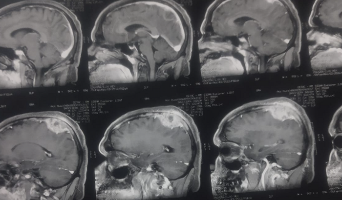 Ajude meu marido fazer uma cirurgia pra remover um tumor no cérebro