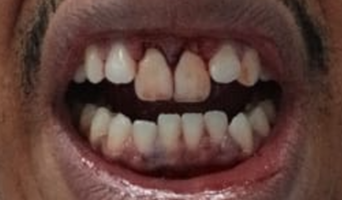 Tratamento dentes e maxilar Chorão