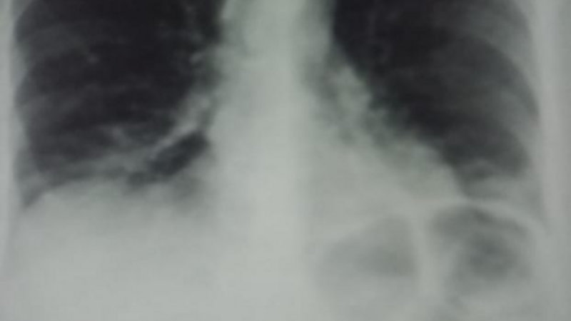 Ajuda para remédio para endemopulmonar de 15 em 1 