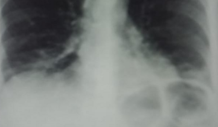 Ajuda para remédio para endemopulmonar de 15 em 1 