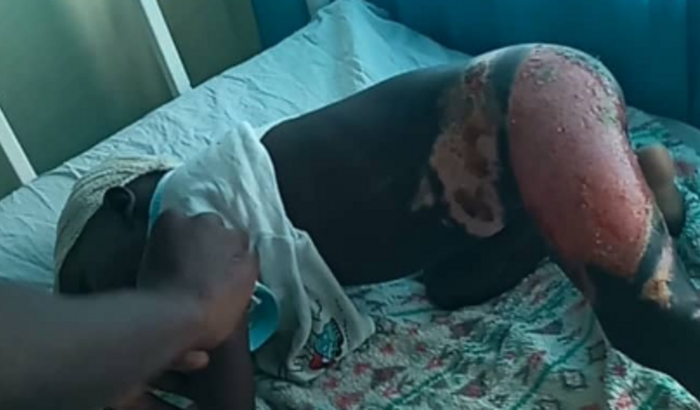 Ajuda no tratamento das queimaduras do pequeno Malcolm de Uganda
