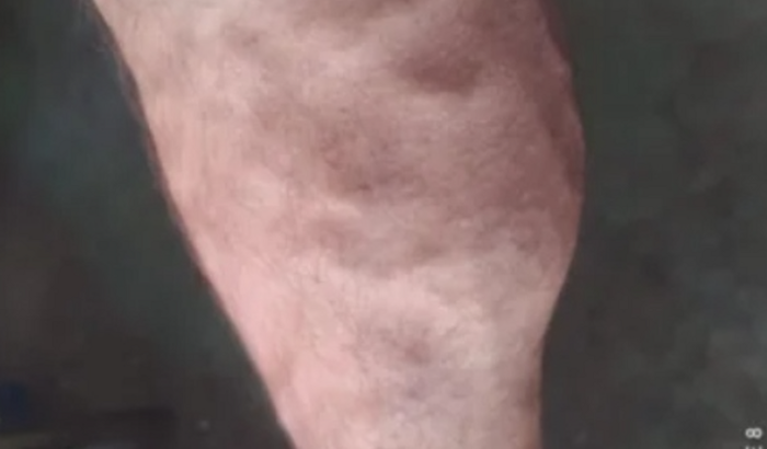 Cirurgia de retirada de véias