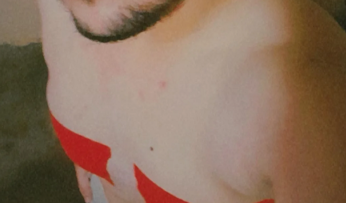 Mastectomia Masculina