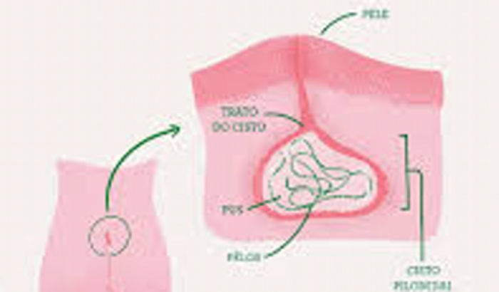 Cirurgia Cisto Pilonidal da Manu