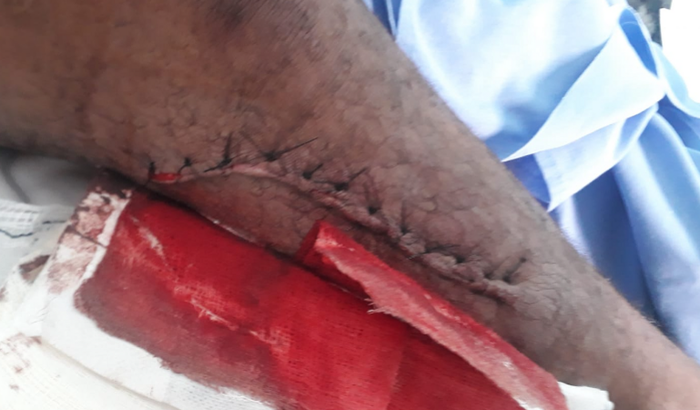 Recuperação de acidente de trabalho