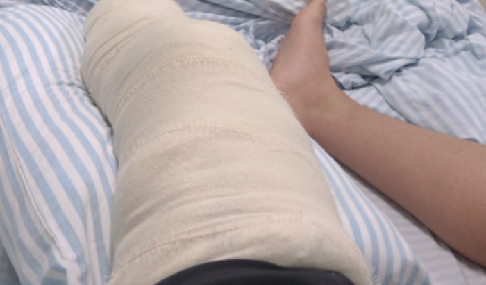 Cirurgia de joelho do Rafael Zanette