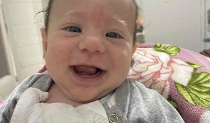 Cirurgia Cranioestenose Caetano