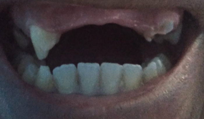 Fazer um implante dentário