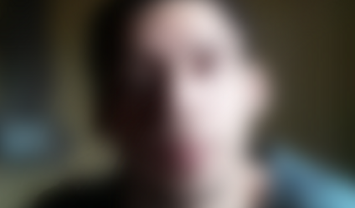 Adenectomia axilar urgente 