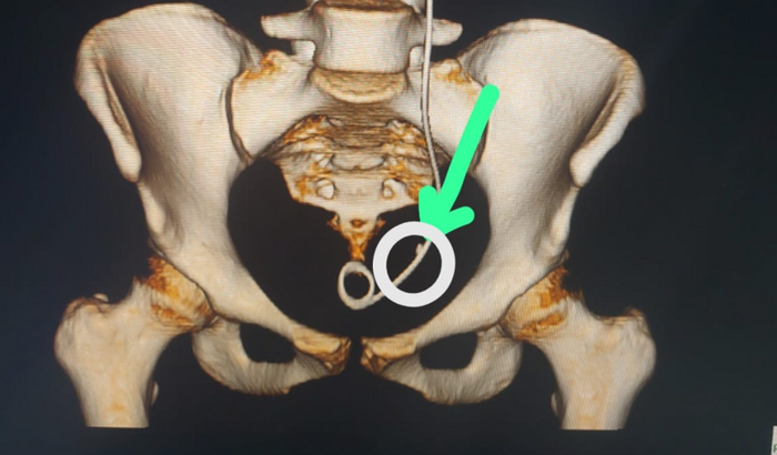 Cirúrgia de retirada de pedra no rim da Julia