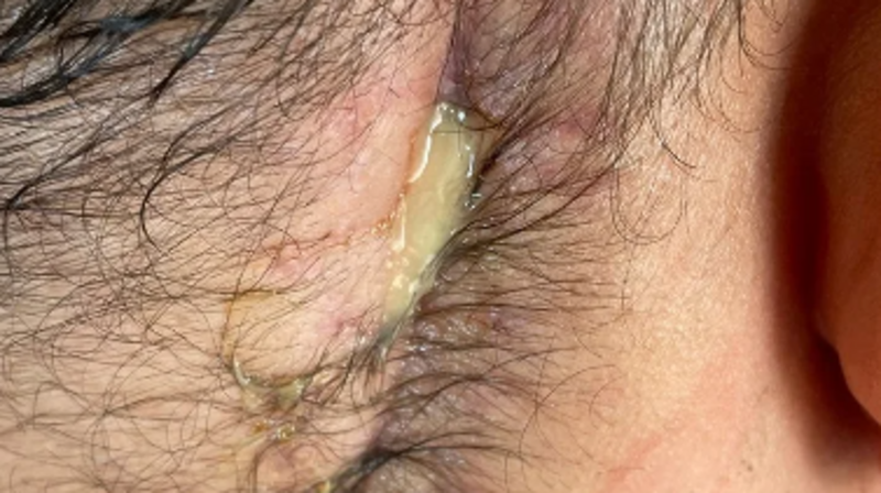 Tratamento neuralgia do trigêmeo. Fechamento de ferida aberta 