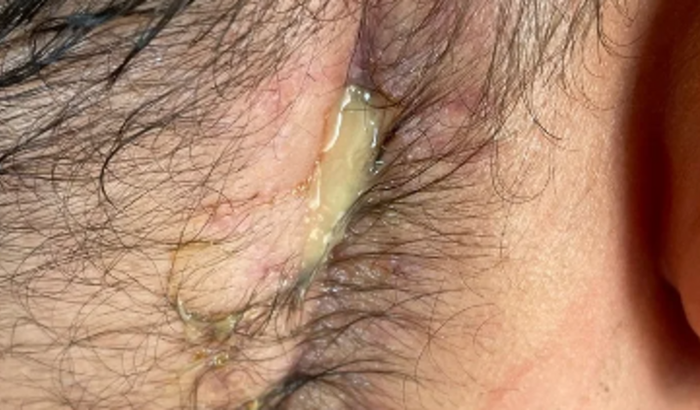 Tratamento neuralgia do trigêmeo. Fechamento de ferida aberta