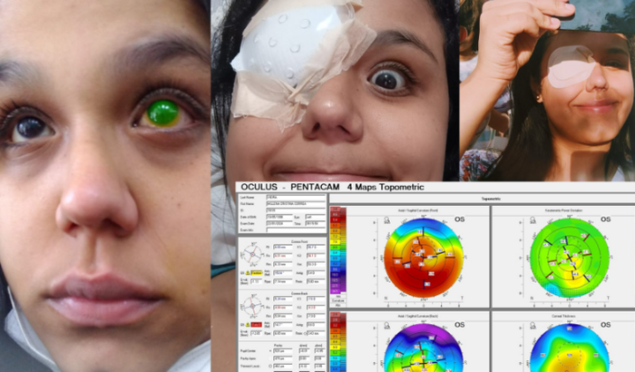 Ajuda para transplante de Córnea