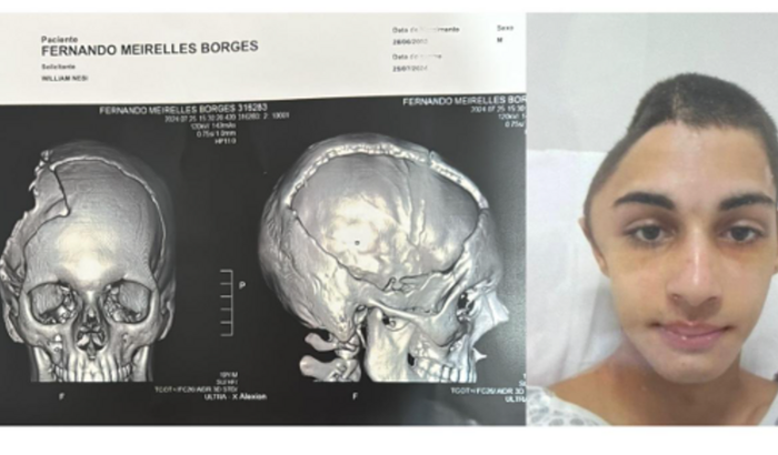 Cranioplastia do Fernando