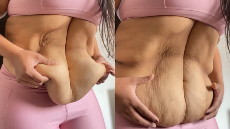 imagem da vaquinha Abdomnoplastia e mastopexia