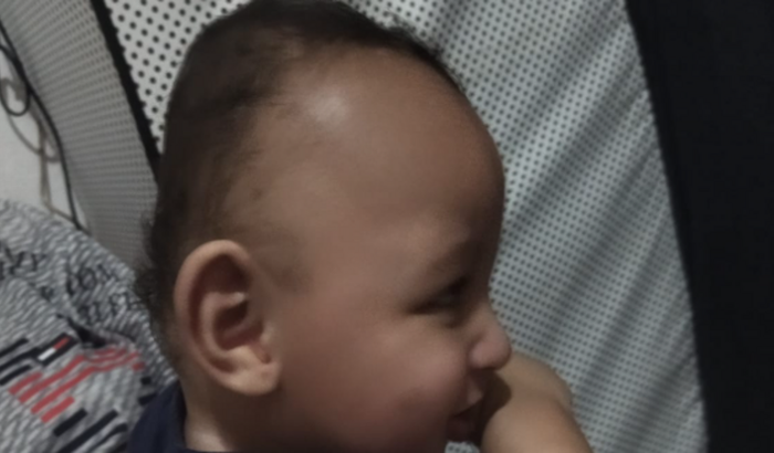 Capacete de assimetria craniana pra bebê