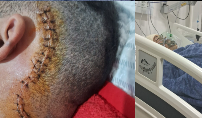 Pagar Cirurgia Da neuralgia do trigemio