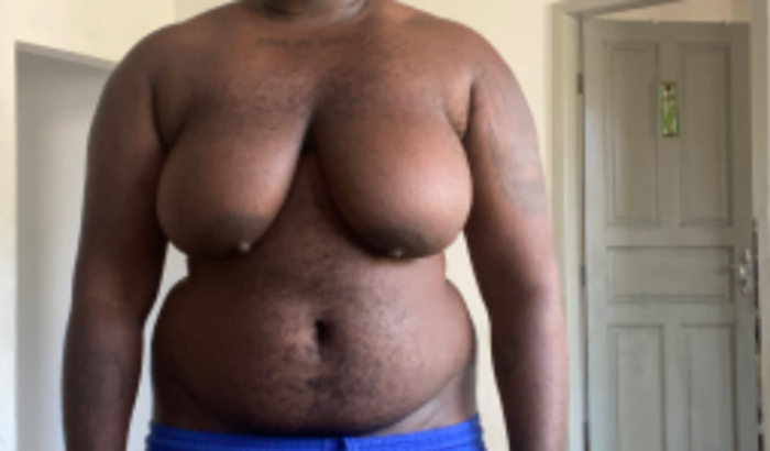 Mastectomia do Nathan