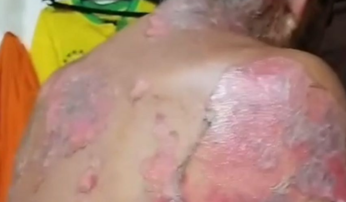 Ajude o Glailson no tratamento da doença Pênfigo Foliáceo