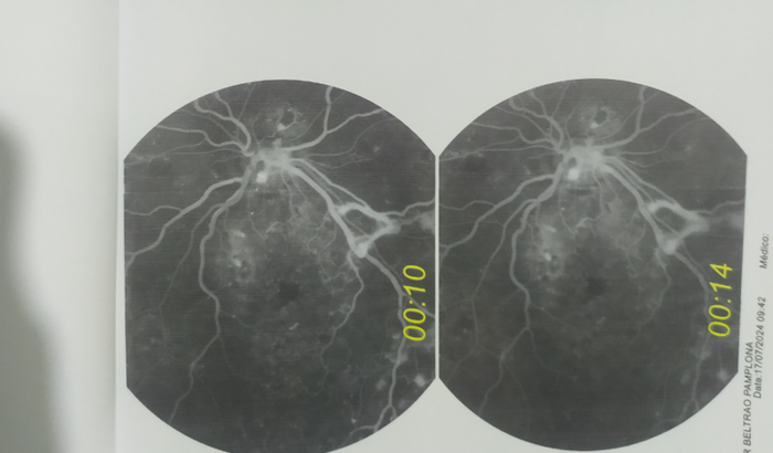 Ajuda para procedimento nos dois olhos de INJEÇÃO INTRA VITREO
