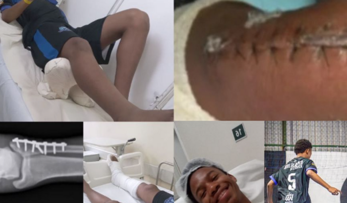 Ajuda para recuperação do Lucas (Fratura)