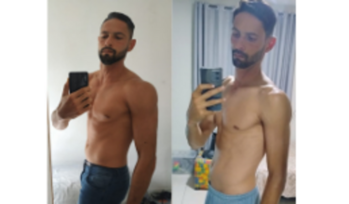 Cirurgia POEM para Acalásia/Megaesôfago de Michel