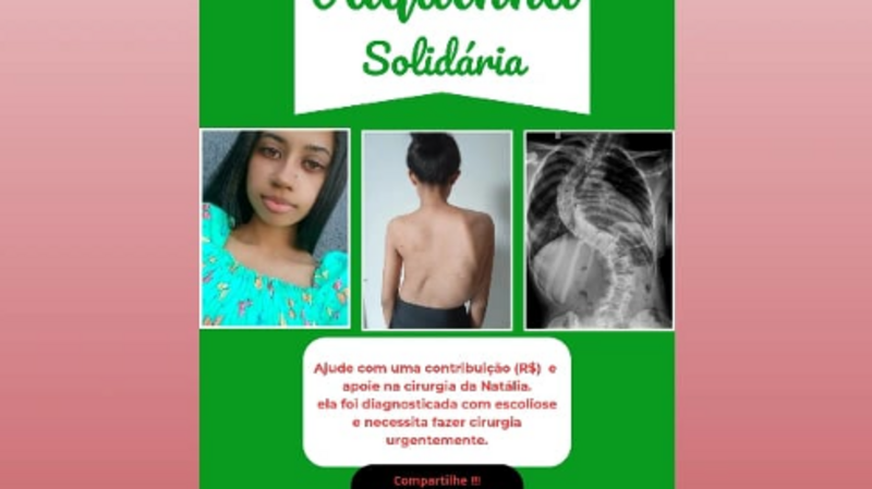 Vaquinha para cirurgia de escoliose da Natália