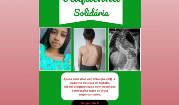 Vaquinha para cirurgia de escoliose da Natália