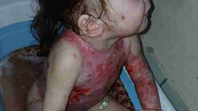 Ajuda pra compras de curativos e tratamento da doença rara epidermolise bolhosa 🦋 