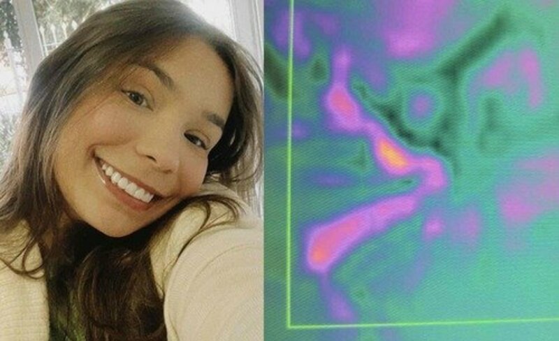 5º cirurgia - reconstituição do canal biliar.