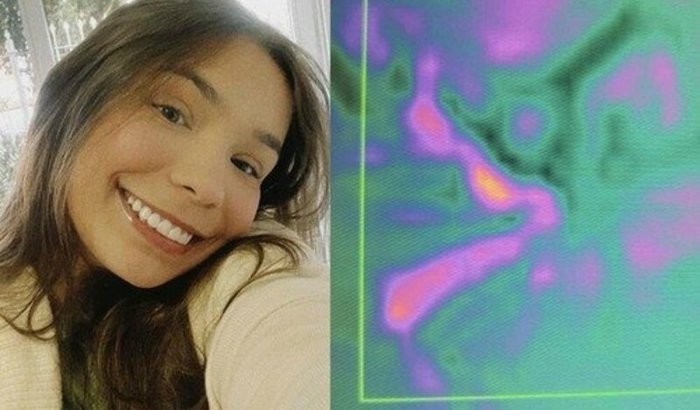 5º cirurgia - reconstituição do canal biliar.