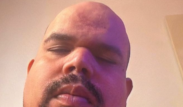 TRANSPLANTE CAPILAR DO MIBI