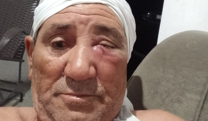 Cirugia do canal lacrimal(Dacriocistorrinostomia com sonda de Crawford