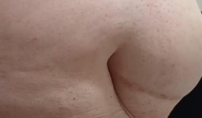 operação de uma hérnia ventral gigante