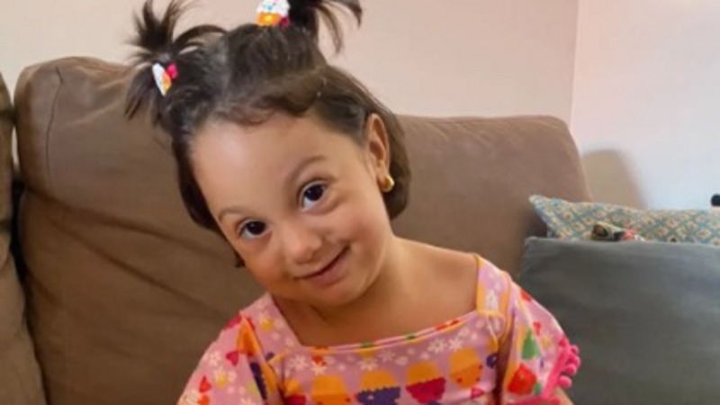 Ajude Lívia, cirurgia de  TRIGONOCEFALIA  