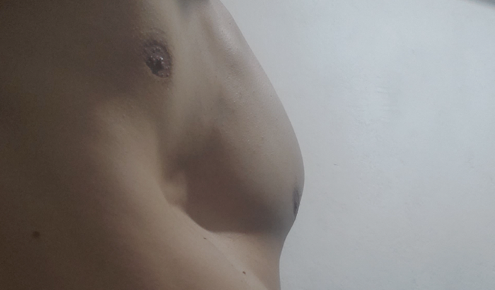 CIRURGIA PECTUS EXCAVATUM - Deformidade torácica