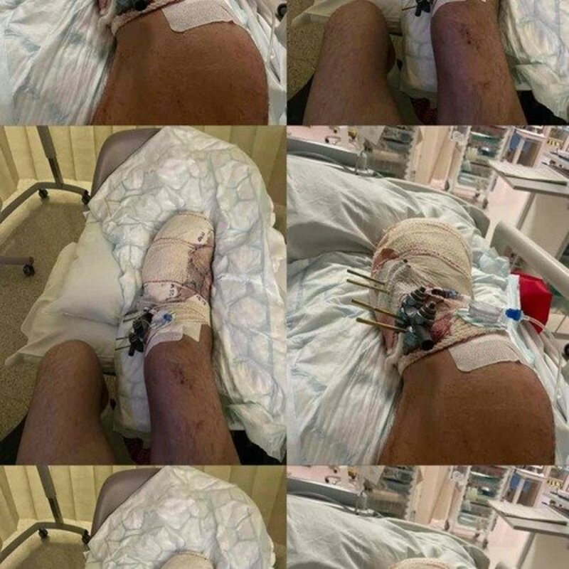 Vakinha / custear despesas do acidente do Lucas