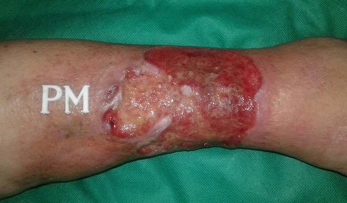 Tratamento de Ulcera venosa na perna