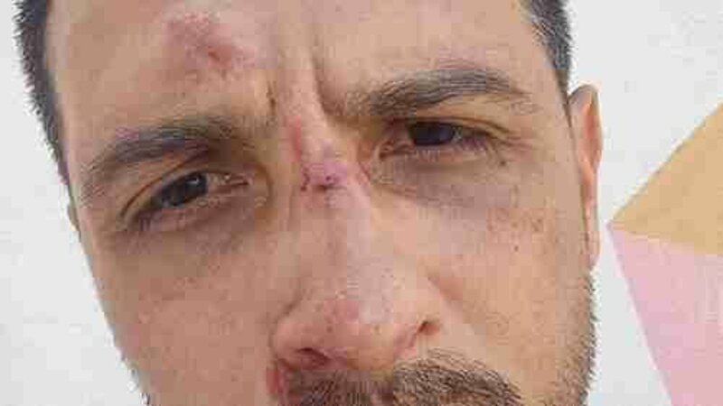 Ajuda Para operar meu nariz quebrado 