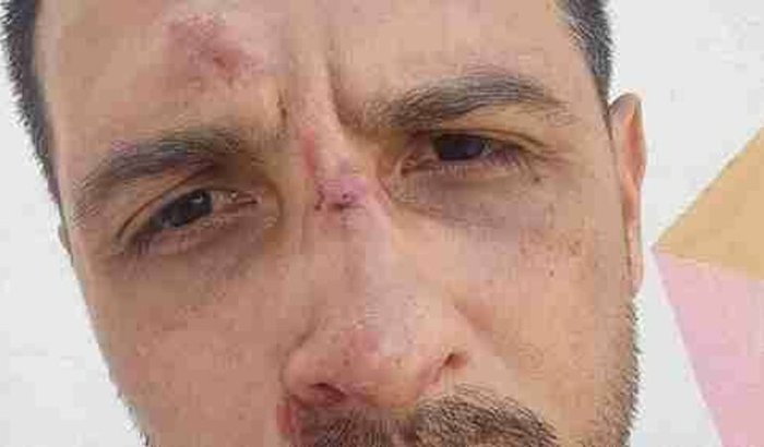 Ajuda Para operar meu nariz quebrado 