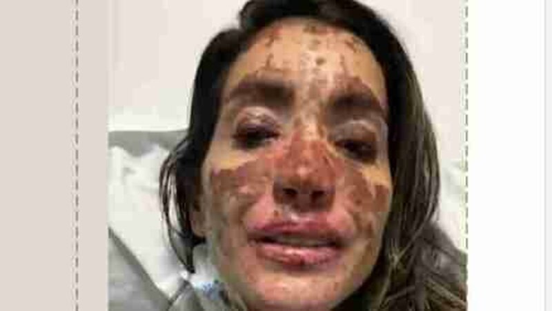 Superando a Síndrome de Stevens-Johnson