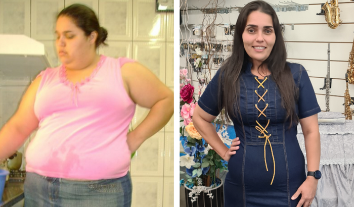 Retirada de pele PryMazzei, após eliminar 71kg