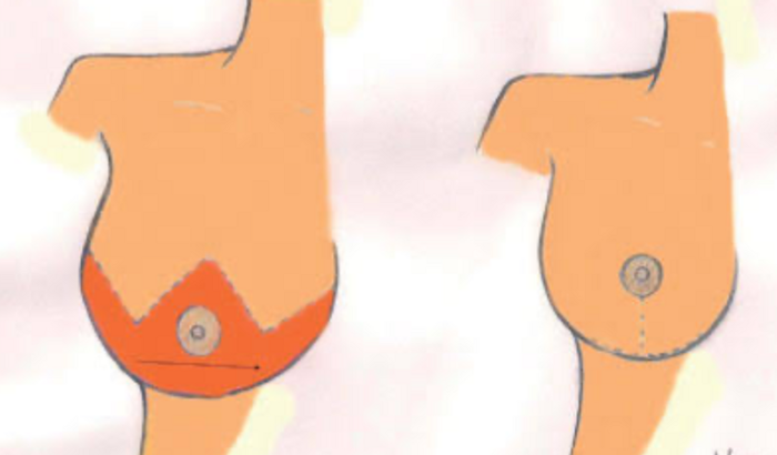 Ajude-me a Superar a Gigantomastia