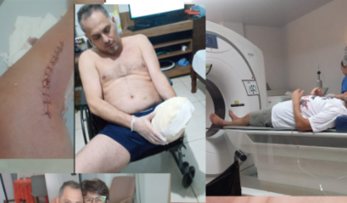 Prótese Perna Esquerda (Amputação)