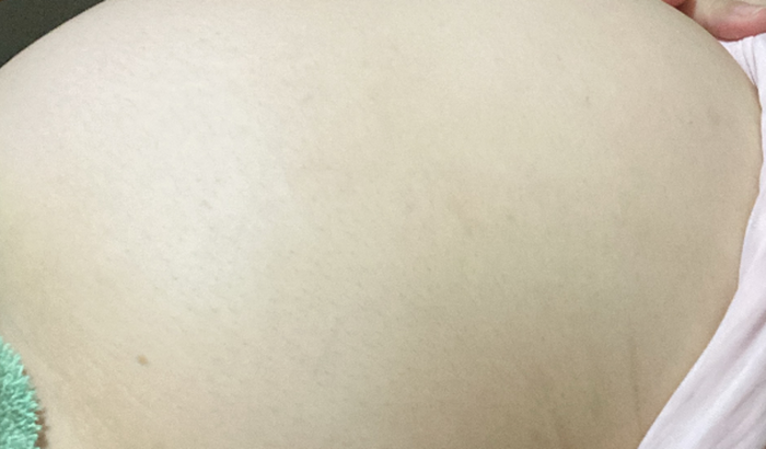Consulta, Exames Endometriose Profunda