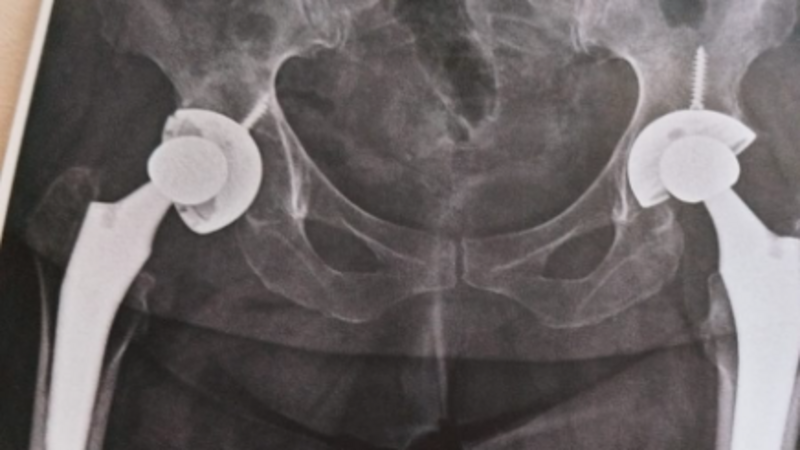 Cirurgia da Prótese de Quadril